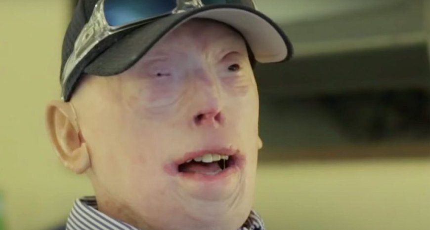 Face Transplant Miracle: Patrick Hardison’s Astonishing Journey from Third-Degree Burns to Today